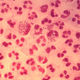 Gonococcal urethritis under the microscope. Image: Wikimedia